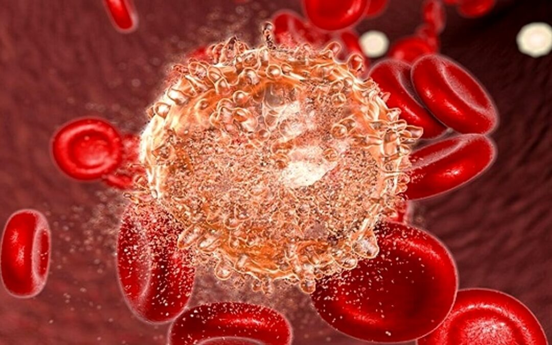 Quando la leucemia può diventare linfoma aggressivo